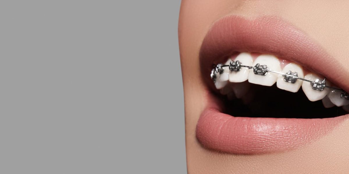 teeth with braces.