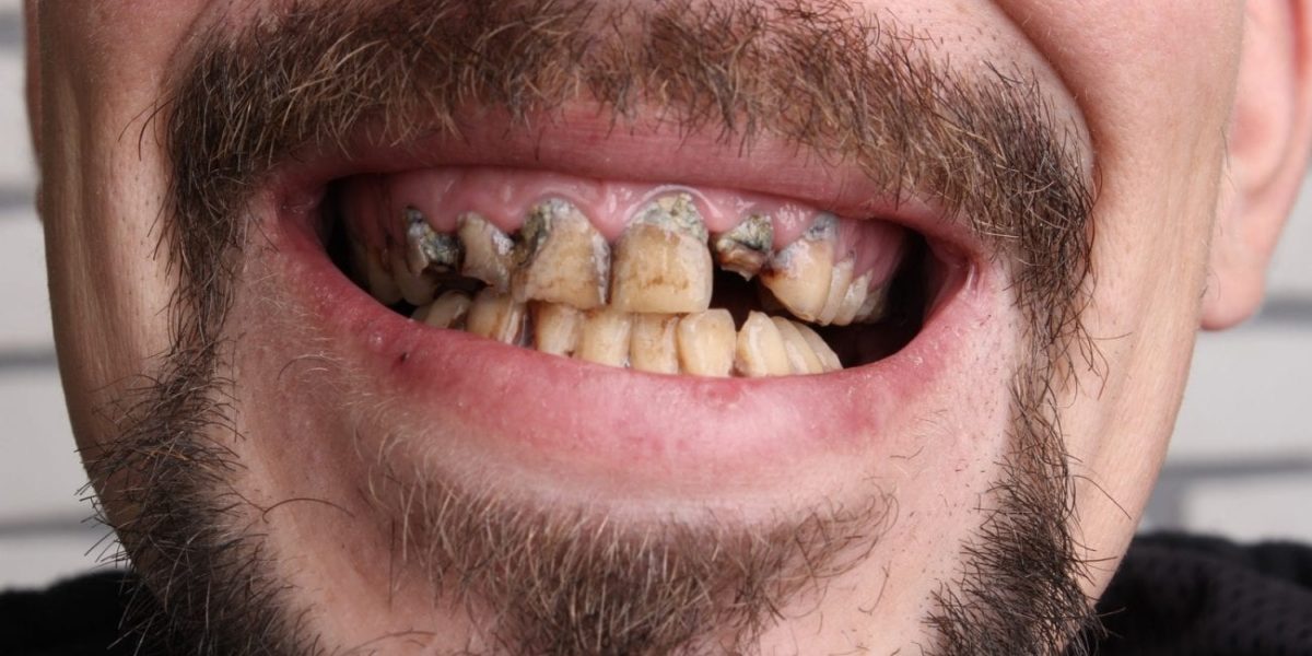 damaged teeth with tobaco