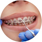 Installation Procedure of Braces in Surrey