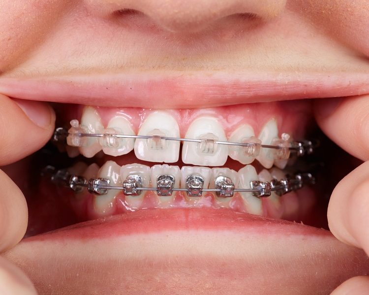 avoid-orthodontic-emergencies