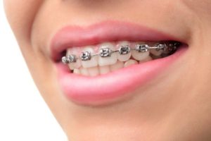 Magnets And Braces What You Should Know South Surrey Smiles