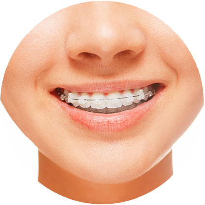 Are Clear Braces and Clear Aligners the Same? - Family Choice