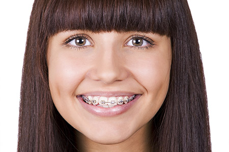 How Much Do Braces Cost? - South Surrey Smiles